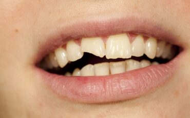 Broken or Fractured Teeth