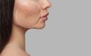 Jaw Reduction Treatments