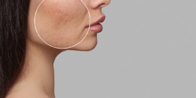 Jaw Reduction Treatments